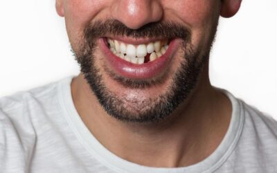 Hai Perso un Dente? Scopri le Conseguenze e le Soluzioni per Ritrovare il Sorriso
