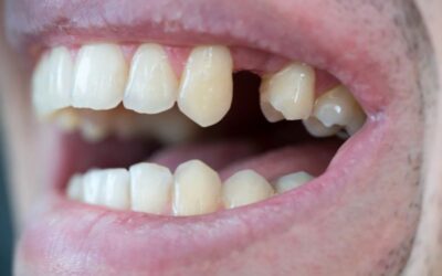Lo Spostamento dei Denti Vicini: Una Conseguenza della Perdita di un Dente