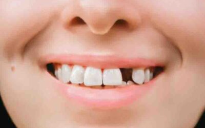 La Mancanza di un Dente e le Difficoltà nella Masticazione: Perché Ogni Dente Conta
