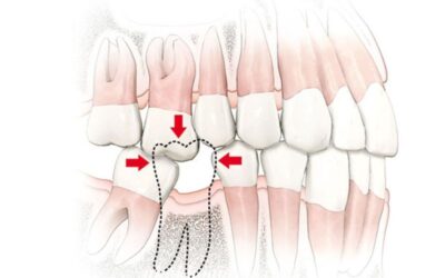 La Perdita di Volume Osseo: Una Conseguenza Nascosta della Mancanza di un Dente