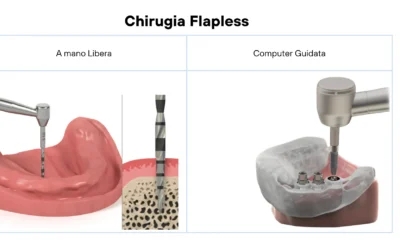 Implantologia dentale flapless: Cosa è DAVVERO.