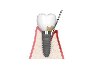 Rigetto degli Impianti Dentali: Mito o Realtà?