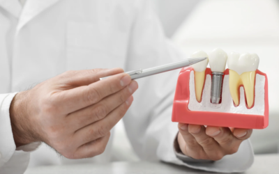 Impianti dentali senza viti? Oppure denti fissi senza impianti? Facciamo Chiarezza