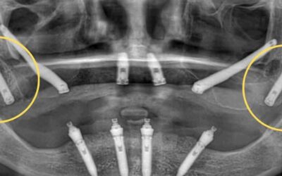 Impianti Dentali senza osso: Soluzioni avanzate per un sorriso fisso