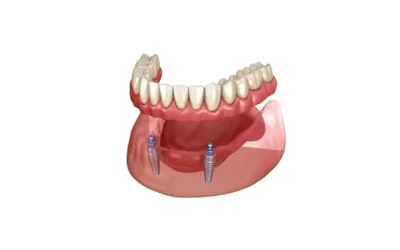 Dentiera con bottoni: fissarla con due impianti è sempre la scelta migliore?
