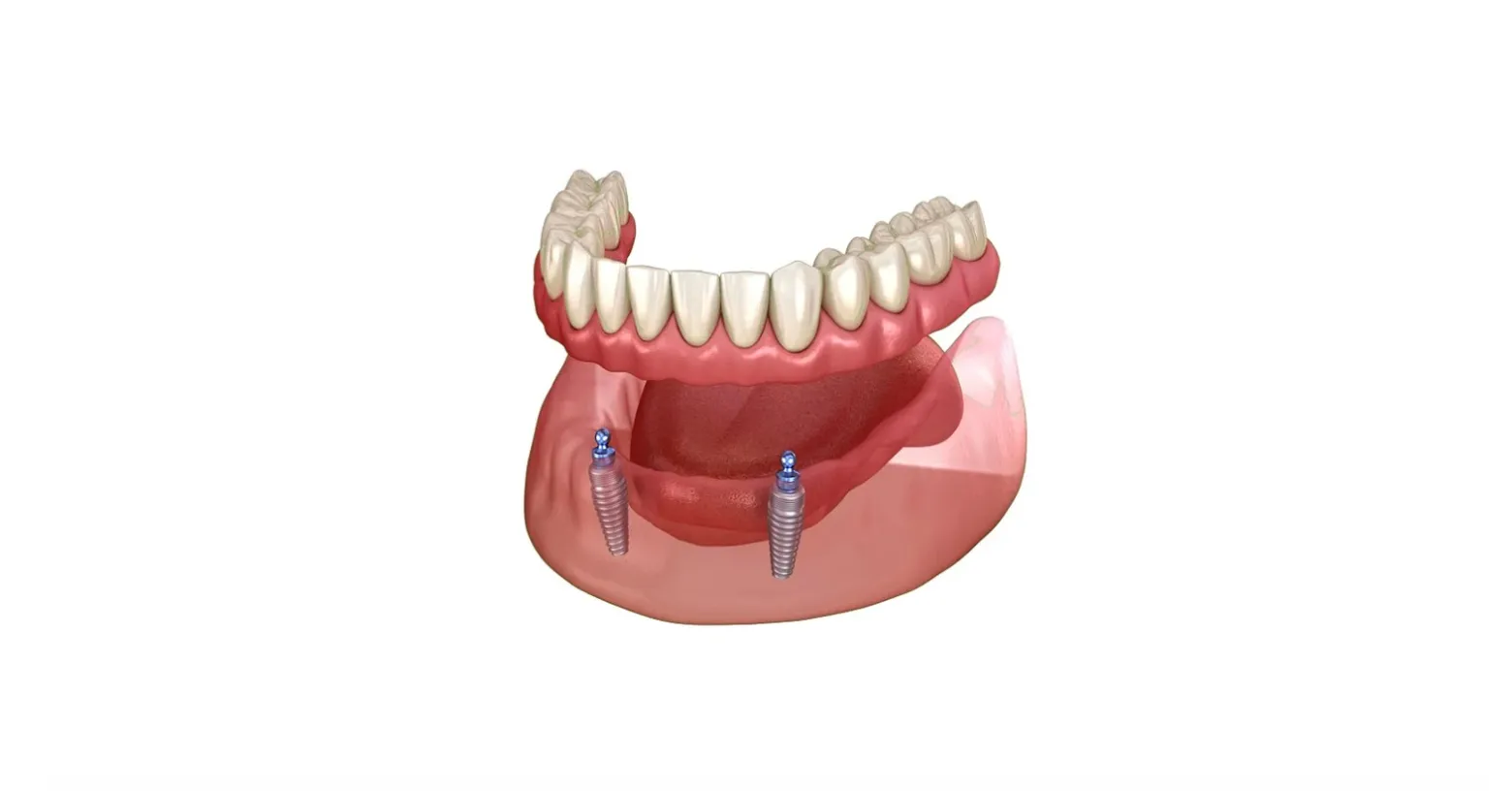 Dentiera con bottoni – fissarla con due impianti è sempre la scelta migliore