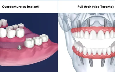 Guida Completa Overdenture o Riabilitazione Full Arch Toronto? Per Scegliere la Soluzione Ideale