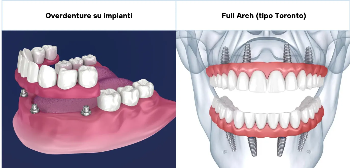 Guida Completa Overdenture o Riabilitazione Full Arch Toronto Per Scegliere la Soluzione Ideale_11zon