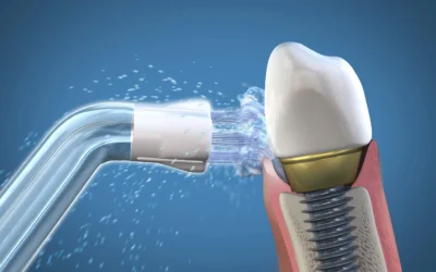 Idropulsore per impianti dentali: un accessorio fondamentale!