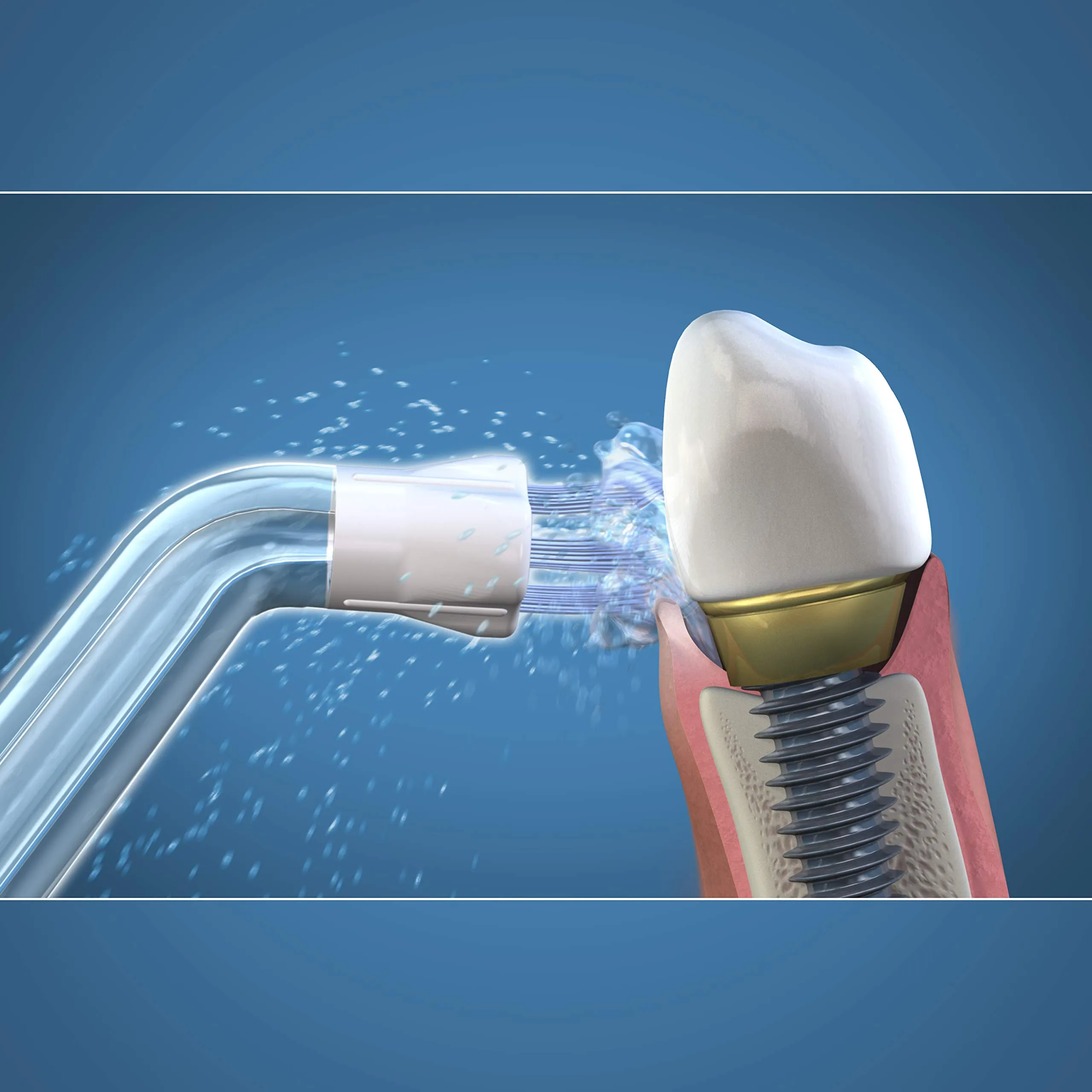 Idropulsore per impianti dentali – un accessorio fondamentale!_11zon