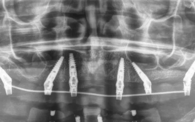 Impianti dentali in arcata superiore: il percorso completo per tornare a sorridere
