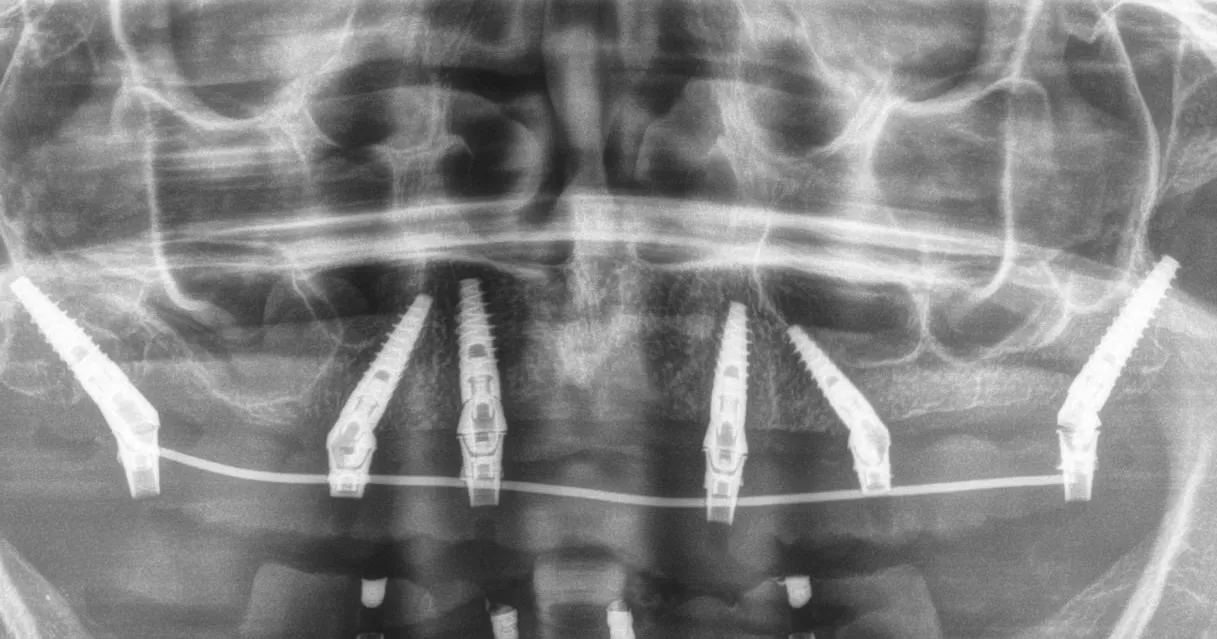 Impianti dentali in arcata superiore, il percorso completo per tornare a sorridere_11zon