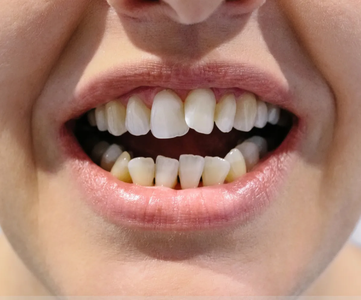 se le faccette dentali possano essere la soluzione giusta per te